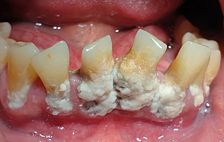 lésions orales potentiellement malignes