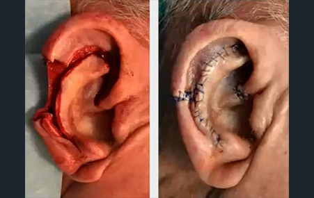 chirurgie reconstruction perte substance oreilles